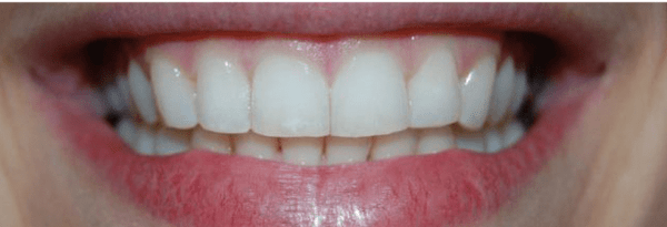 Invisalign Before & After