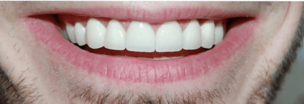 Invisalign Before & After