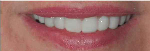 Invisalign Before & After