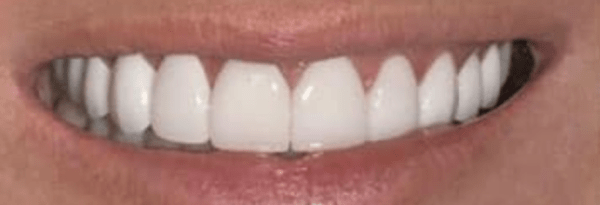 Non-Prep Veneers Before & After