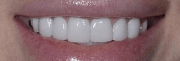 Non-Prep Veneers Before & After