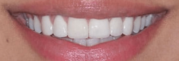 Non-Prep Veneers Before & After