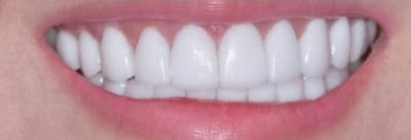 Porcelain Veneers Before & After