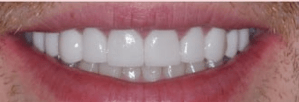 Porcelain Veneers Before & After