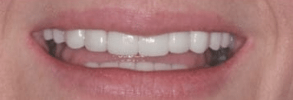 Porcelain Veneers Before & After