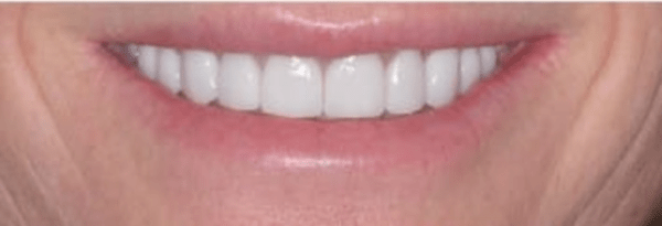 Porcelain Veneers Before & After