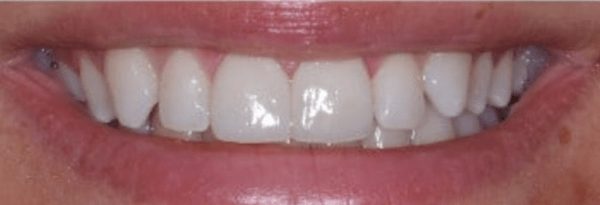 Porcelain Veneers Before & After