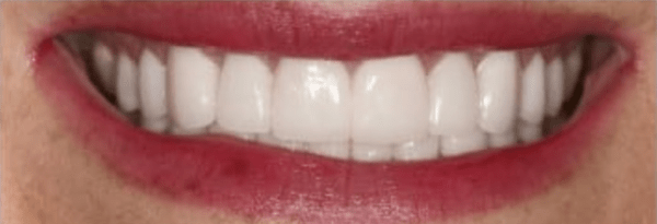 Porcelain Veneers Before & After