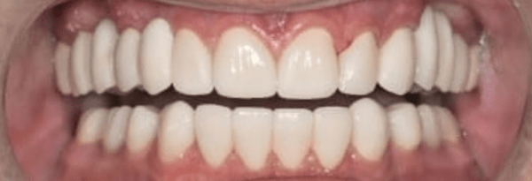 Porcelain Veneers Before & After