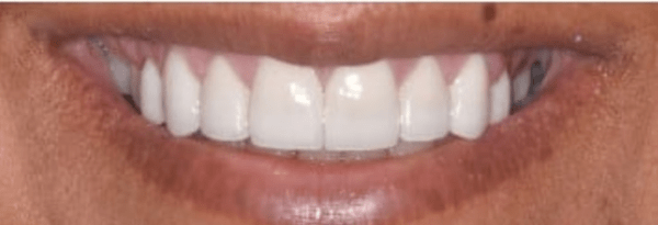Porcelain Veneers Before & After