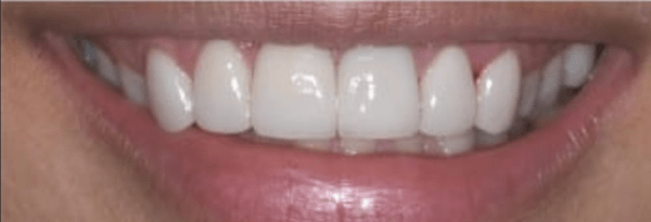 Porcelain Veneers Before & After