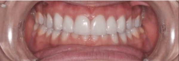 Porcelain Veneers Before & After