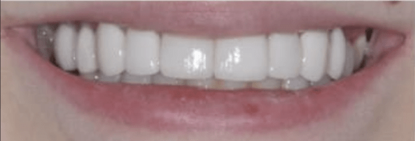 Porcelain Veneers Before & After