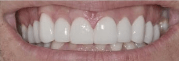 Porcelain Veneers Before & After
