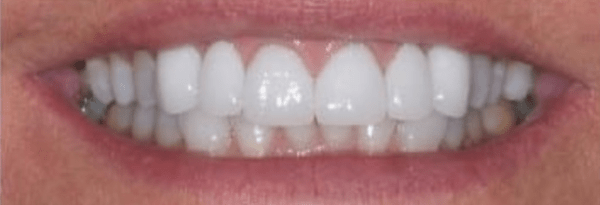Porcelain Veneers Before & After