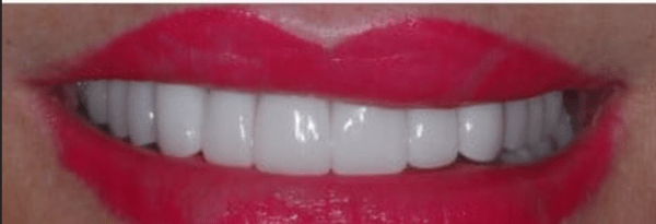 Smile Makeover Before & After