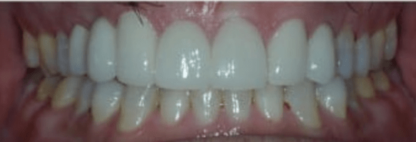 Smile Makeover Before & After