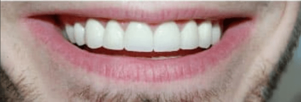 Smile Makeover Before & After