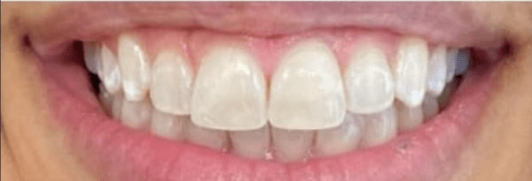 Smile Makeover Before & After