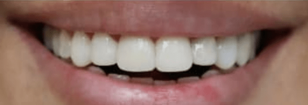 Teeth-in-a-Day Before & After
