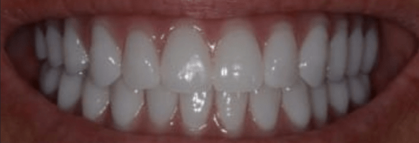Teeth-in-a-Day Before & After