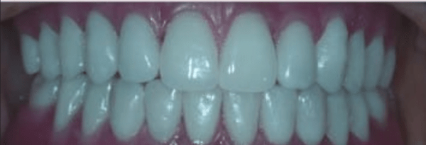 Teeth-in-a-Day Before & After