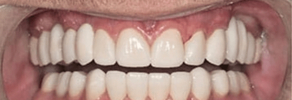 Non-Prep Veneers Before & After