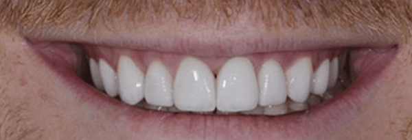 Non-Prep Veneers Before & After