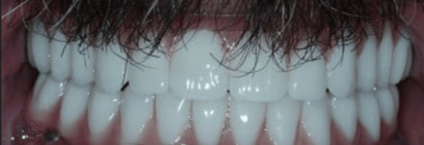 Teeth-in-a-Day Before & After