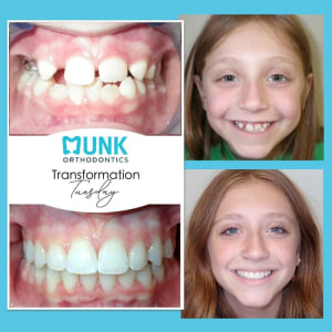 Transformation Tuesday - Munk Orthodontics Patient