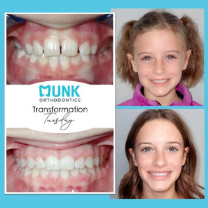 Transformation Tuesday - Munk Orthodontics Patient