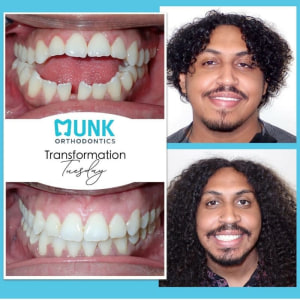 Transformation Tuesday - Munk Orthodontics Patient