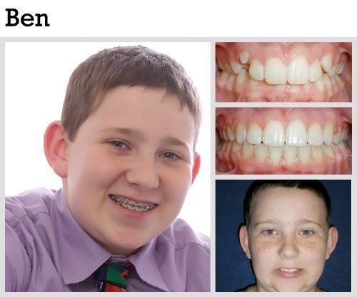 Before & After Patient Photos | Pavlo Orthodontics