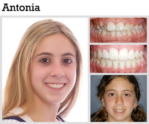 Before & After Patient Photos | Pavlo Orthodontics