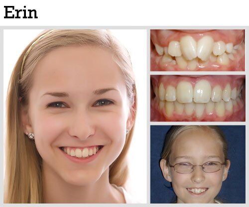 Before & After Patient Photos | Pavlo Orthodontics