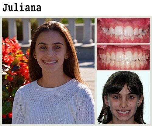 Before & After Patient Photos | Pavlo Orthodontics