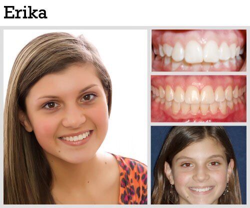 Before & After Patient Photos | Pavlo Orthodontics