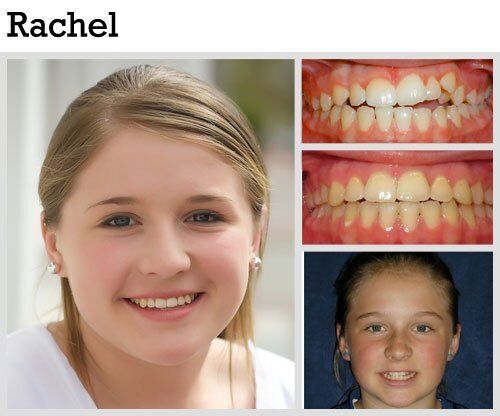 Before & After Patient Photos | Pavlo Orthodontics