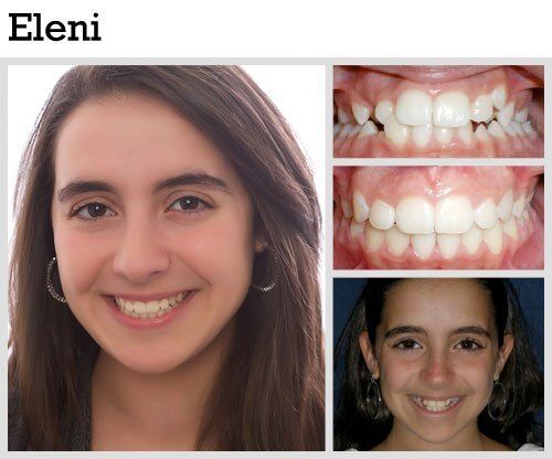 Before & After Patient Photos | Pavlo Orthodontics