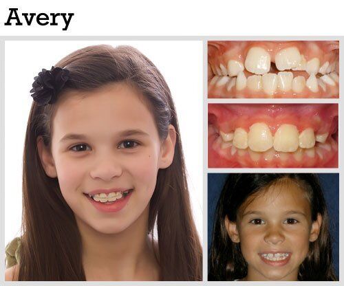 Before & After Patient Photos | Pavlo Orthodontics