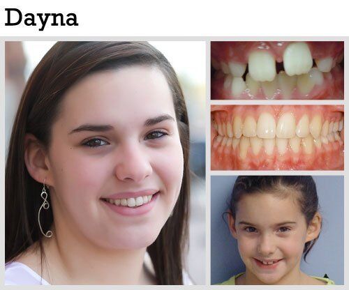 Before & After Patient Photos | Pavlo Orthodontics