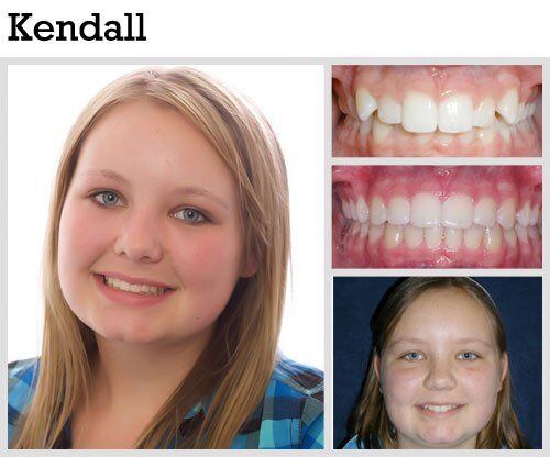 Before & After Patient Photos | Pavlo Orthodontics