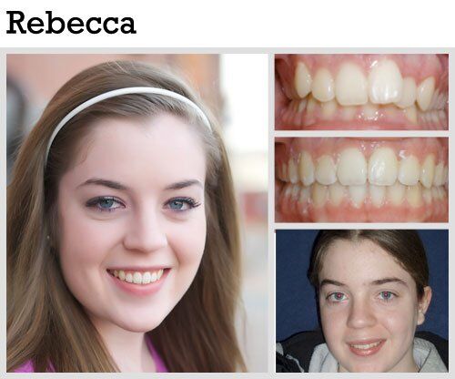 Before & After Patient Photos | Pavlo Orthodontics