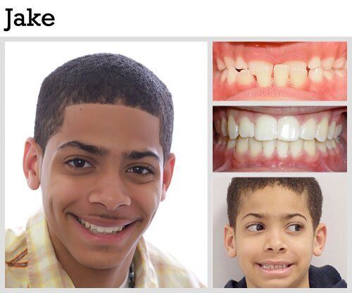 Before & After Patient Photos | Pavlo Orthodontics