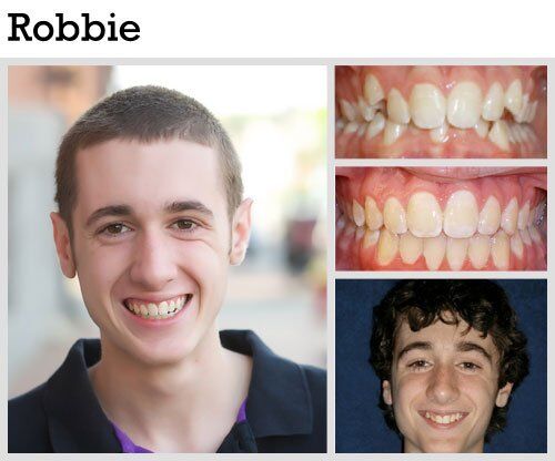 Before & After Patient Photos | Pavlo Orthodontics