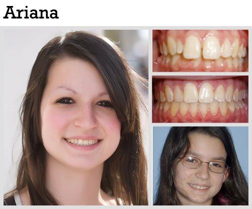 Before & After Patient Photos | Pavlo Orthodontics