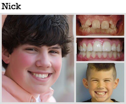 Before & After Patient Photos | Pavlo Orthodontics