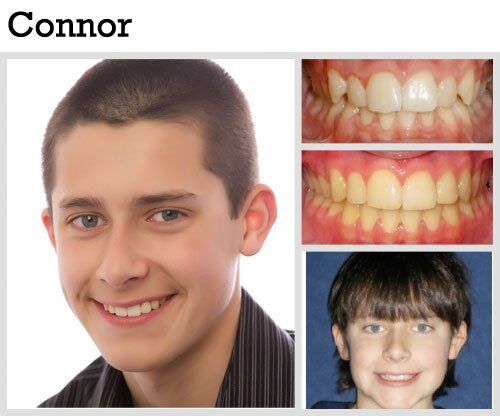 Before & After Patient Photos | Pavlo Orthodontics