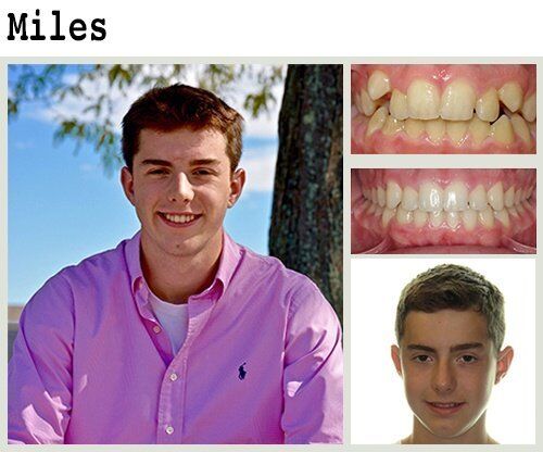 Before & After Patient Photos | Pavlo Orthodontics