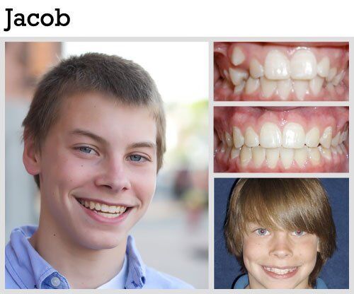 Before & After Patient Photos | Pavlo Orthodontics
